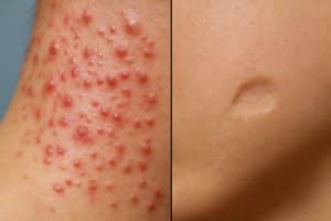 Topical acne treatment products and scar creams illustrating treatment sequence steps